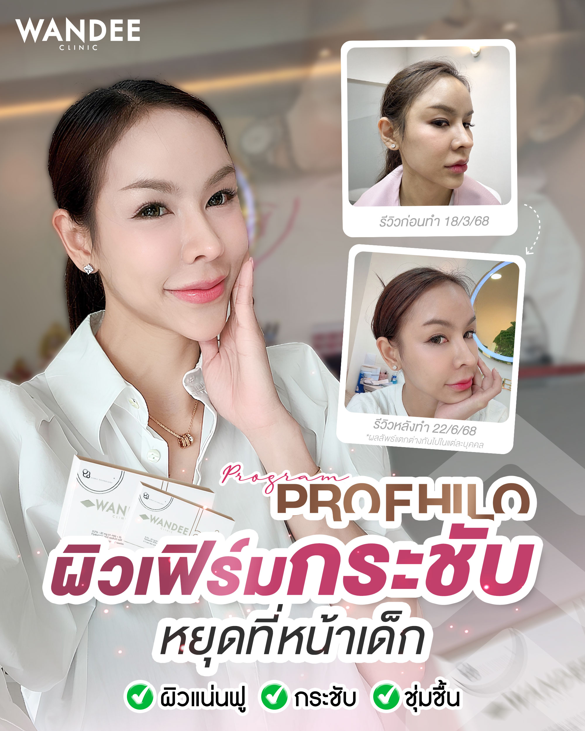 Profhilo นครพนม