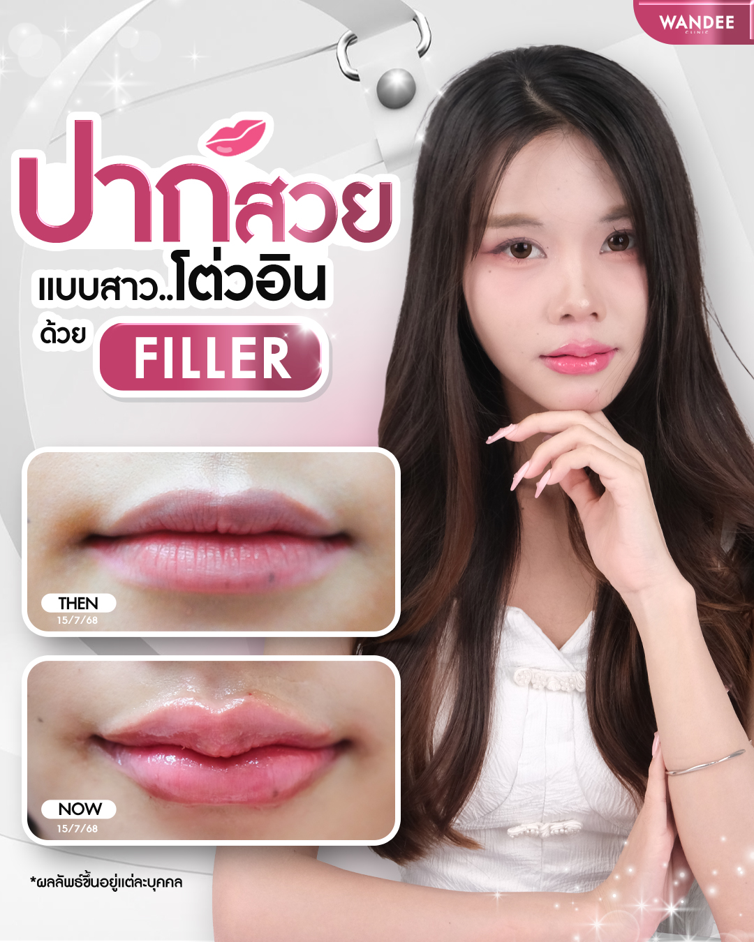 รีวิวฟิลเลอร์